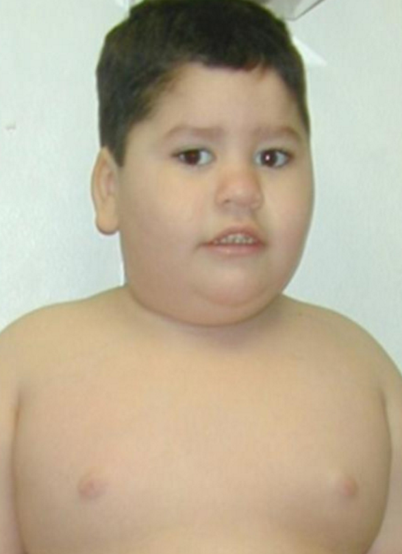 أسئلة شارحة: متلازمة برادر-ويلي (Prader-Willi Syndrome)
