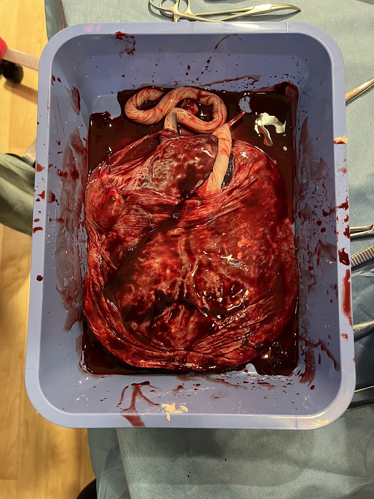 خلايا أمومية غريبة تحرس الجنين من داخل الرحم